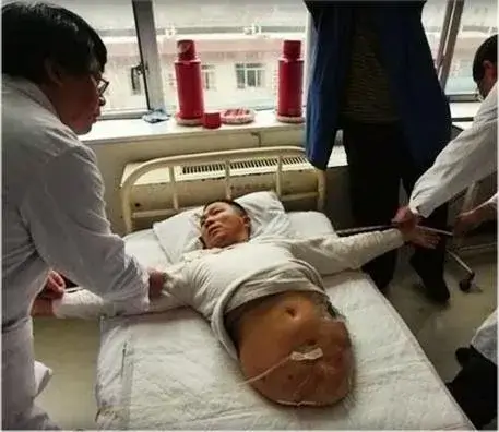 Story of Peng Shuilin Man with only half a body 1