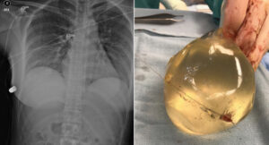 A 30 year old survived a close range gunshot thanks to silicone implant cover