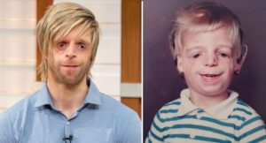 Inspiring story of Jono Lancaster, Abandoned by His mother at birth for this 'defect' on his face