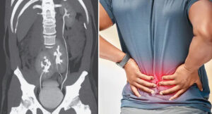 Man discovers he has 3 kidneys after going to doctor for severe back pain
