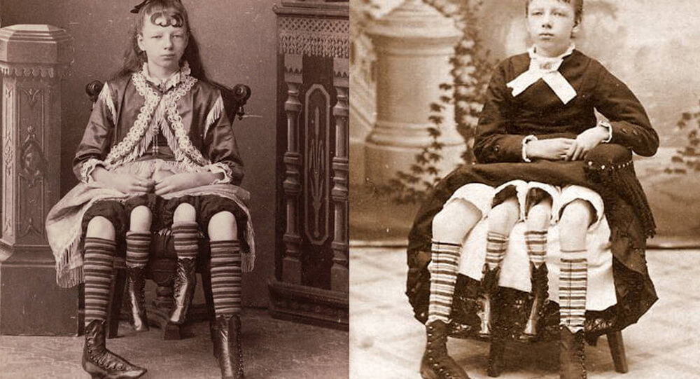 The true story of Josephine Myrtle Corbin, the lady born with four legs and two private parts