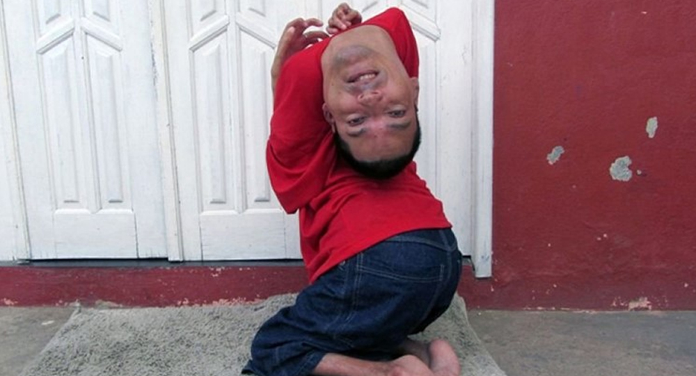Brazilian Man with Rare ‘Upside Down’ Condition Becomes Successful Accountant and Speaker